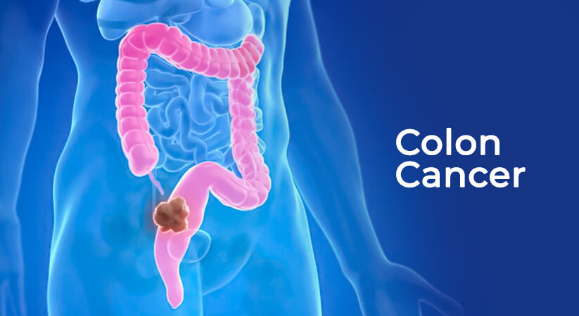 Colorectal Cancer
