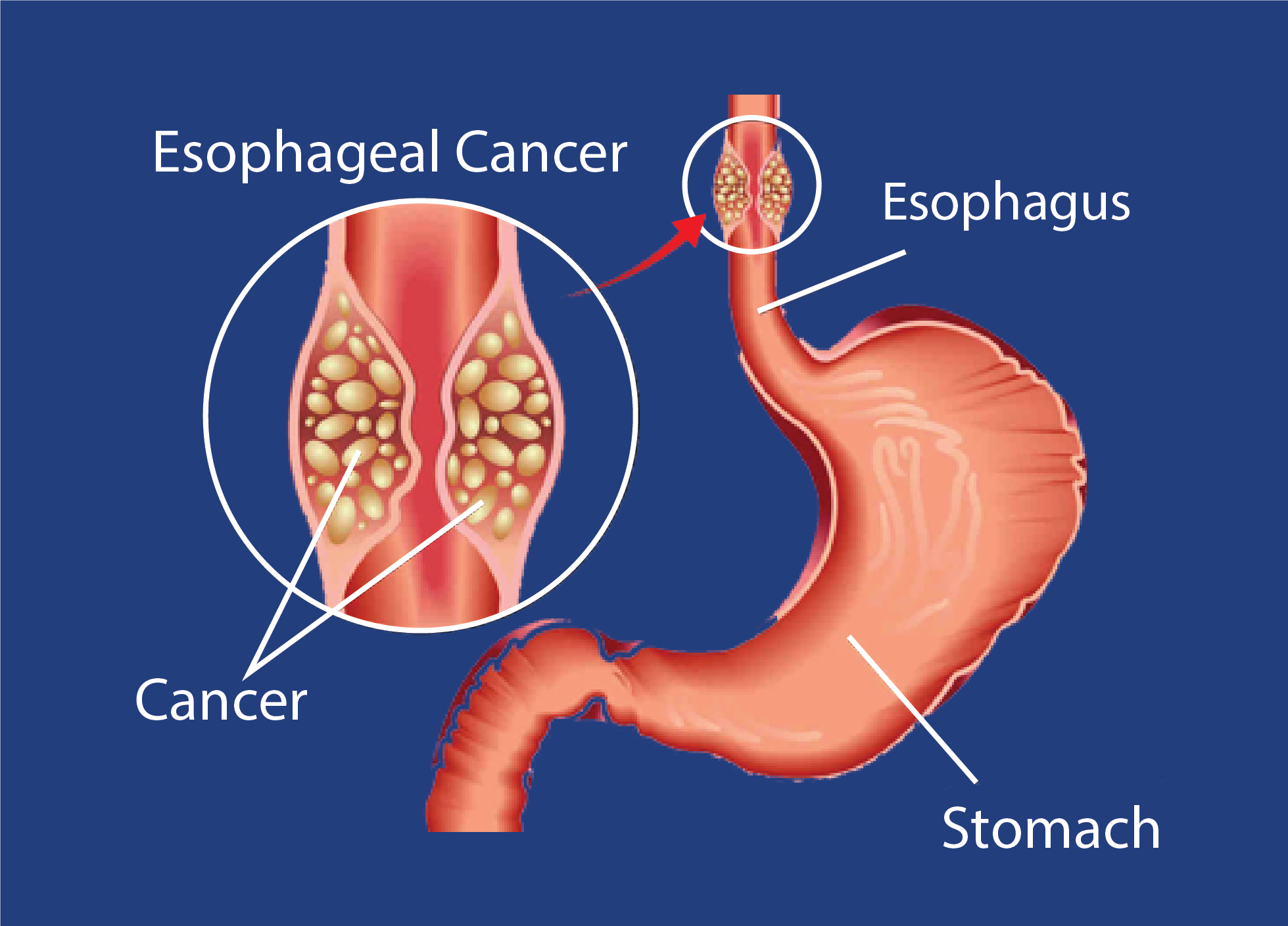 Esophageal Cancer