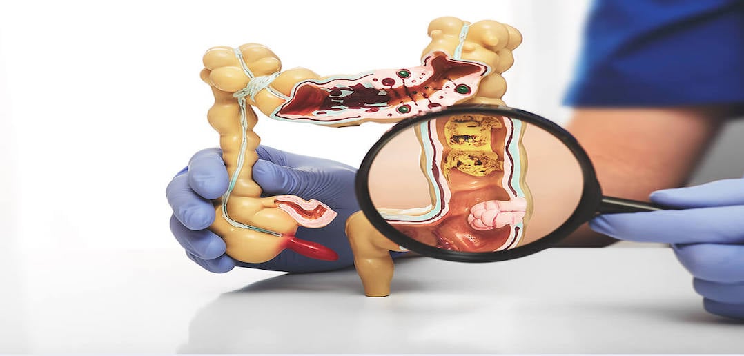 Peritoneal Cancer