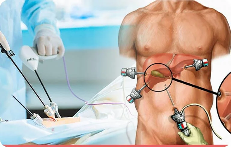 Gallbladder Surgery