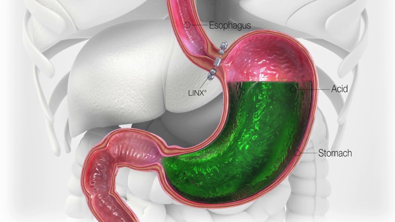 Reflux Surgery