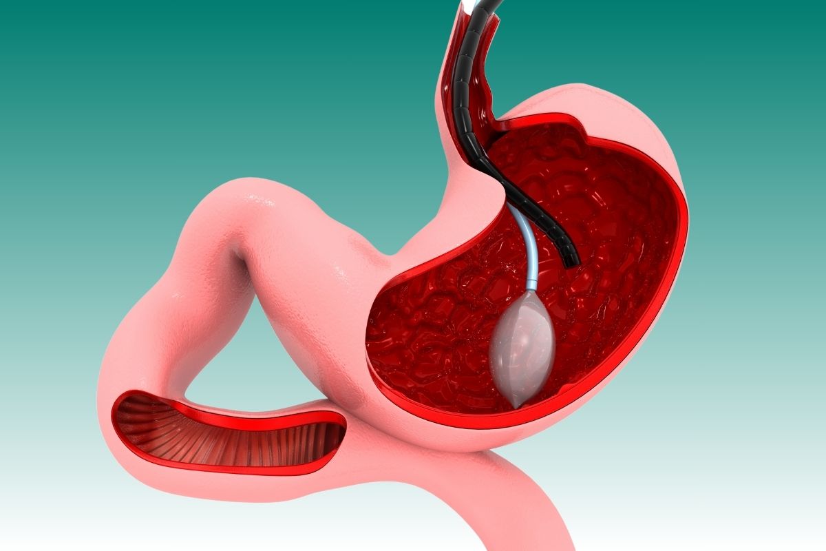 Endoscopic Balloon
