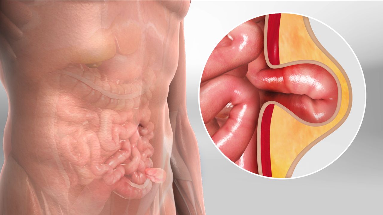 Hernia Surgery