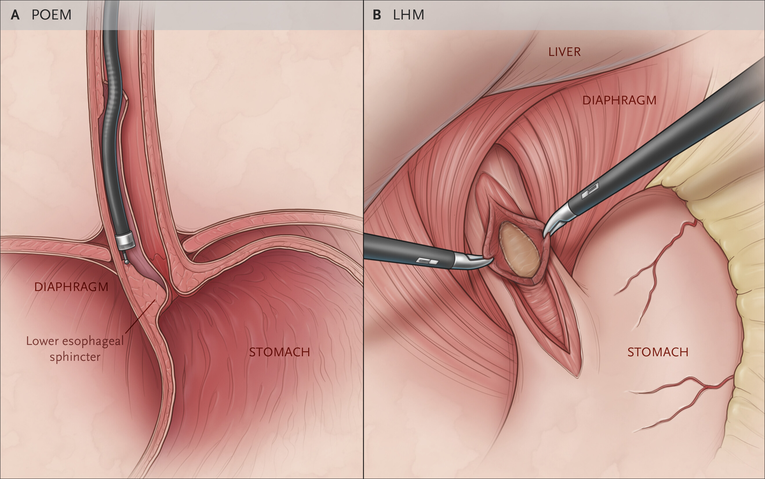 Achalasia Surgery