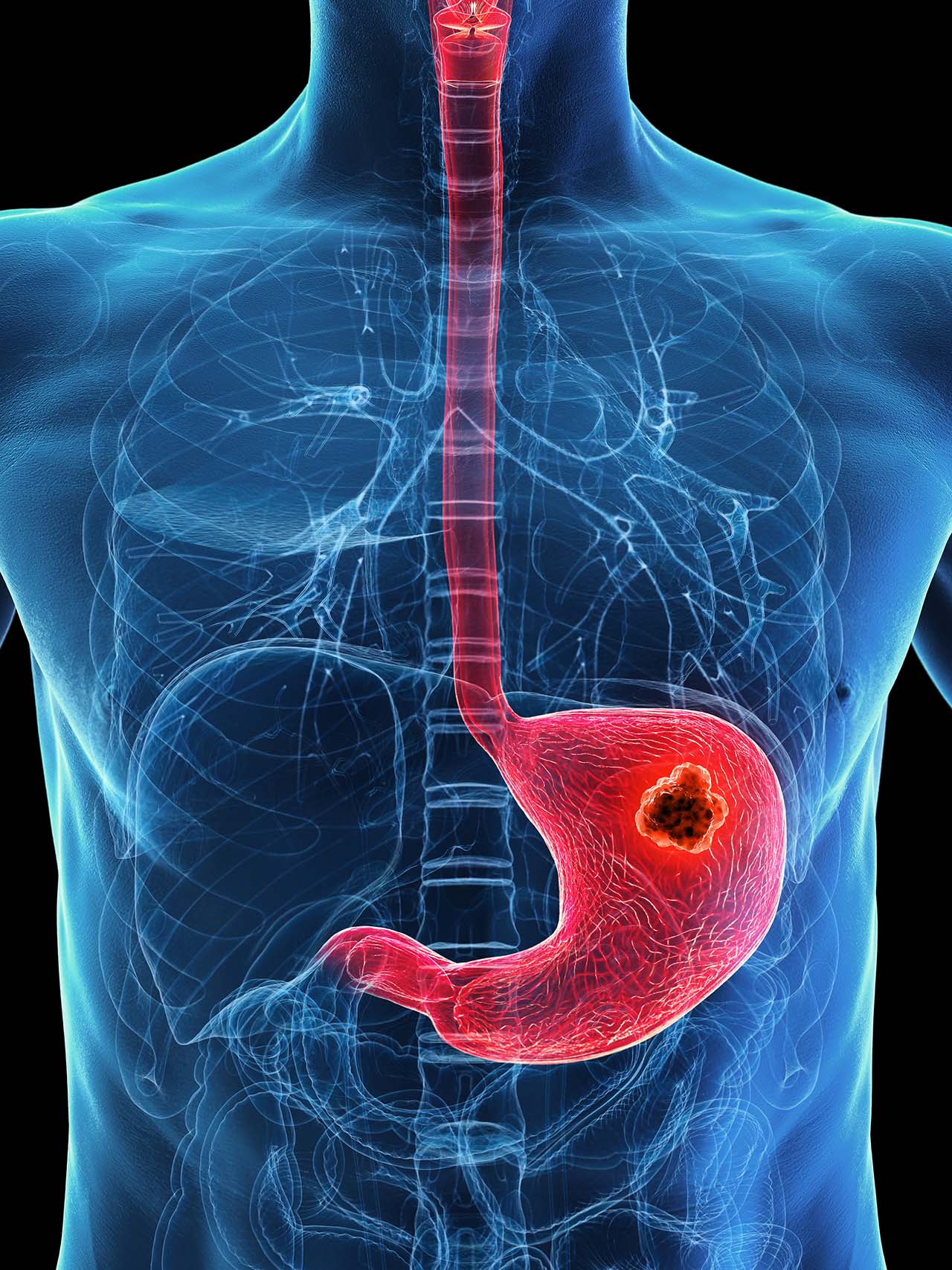 Stomach Cancer Surgery