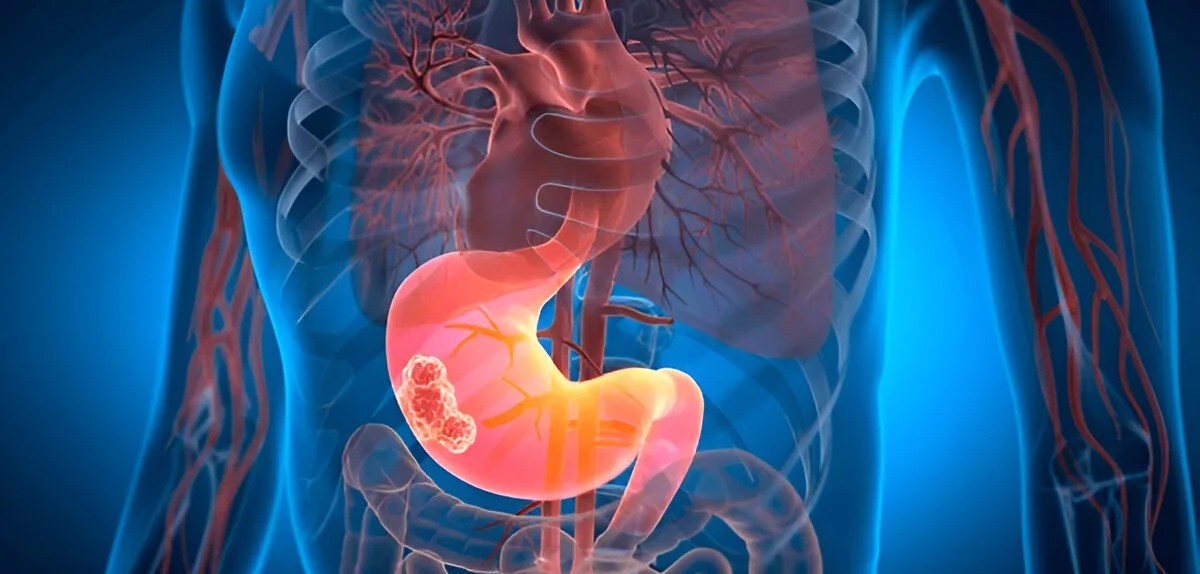 GI Cancer Surgery