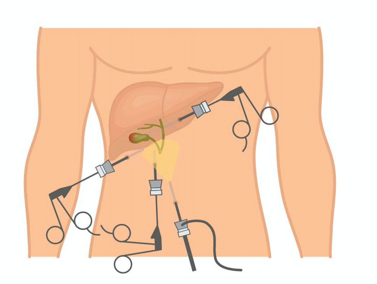 Gallstone Surgery