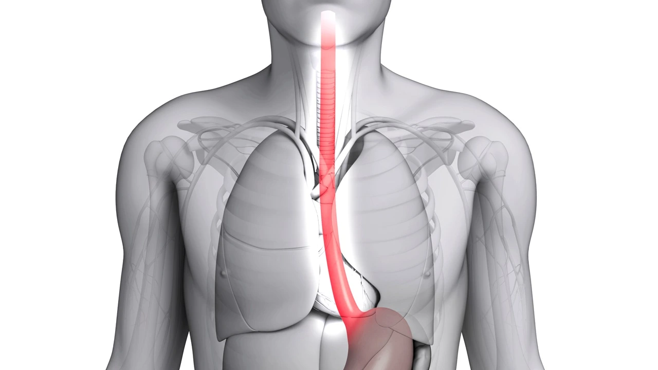 Esophageal Cancer Surgery