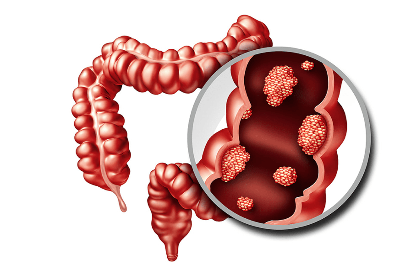Rectum Cancer Anatomy