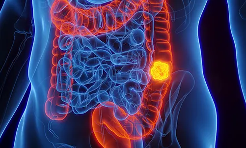 Small Intestine Cancer Pathology