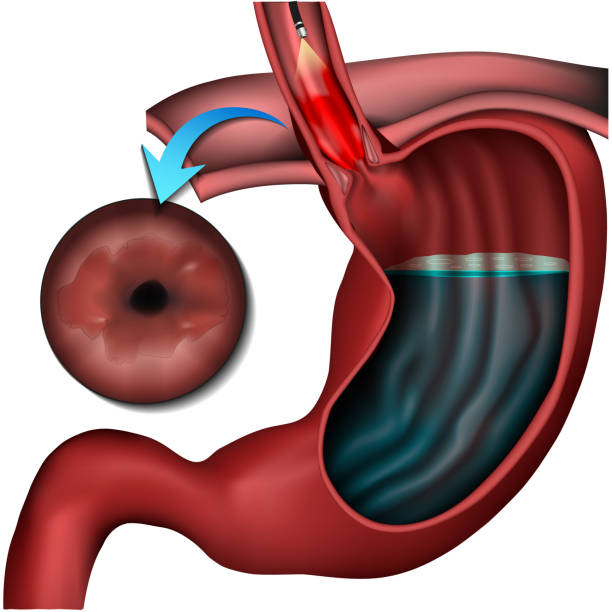 Endoscopic Achalasia Treatment