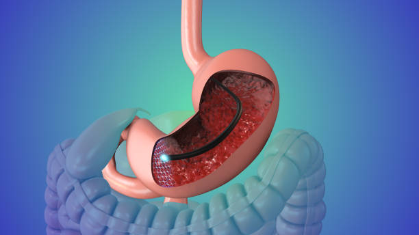 Endoscopic Reflux Treatment
