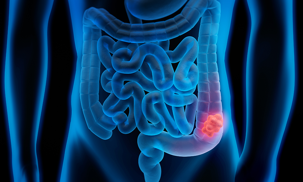 Colon Cancer Anatomy