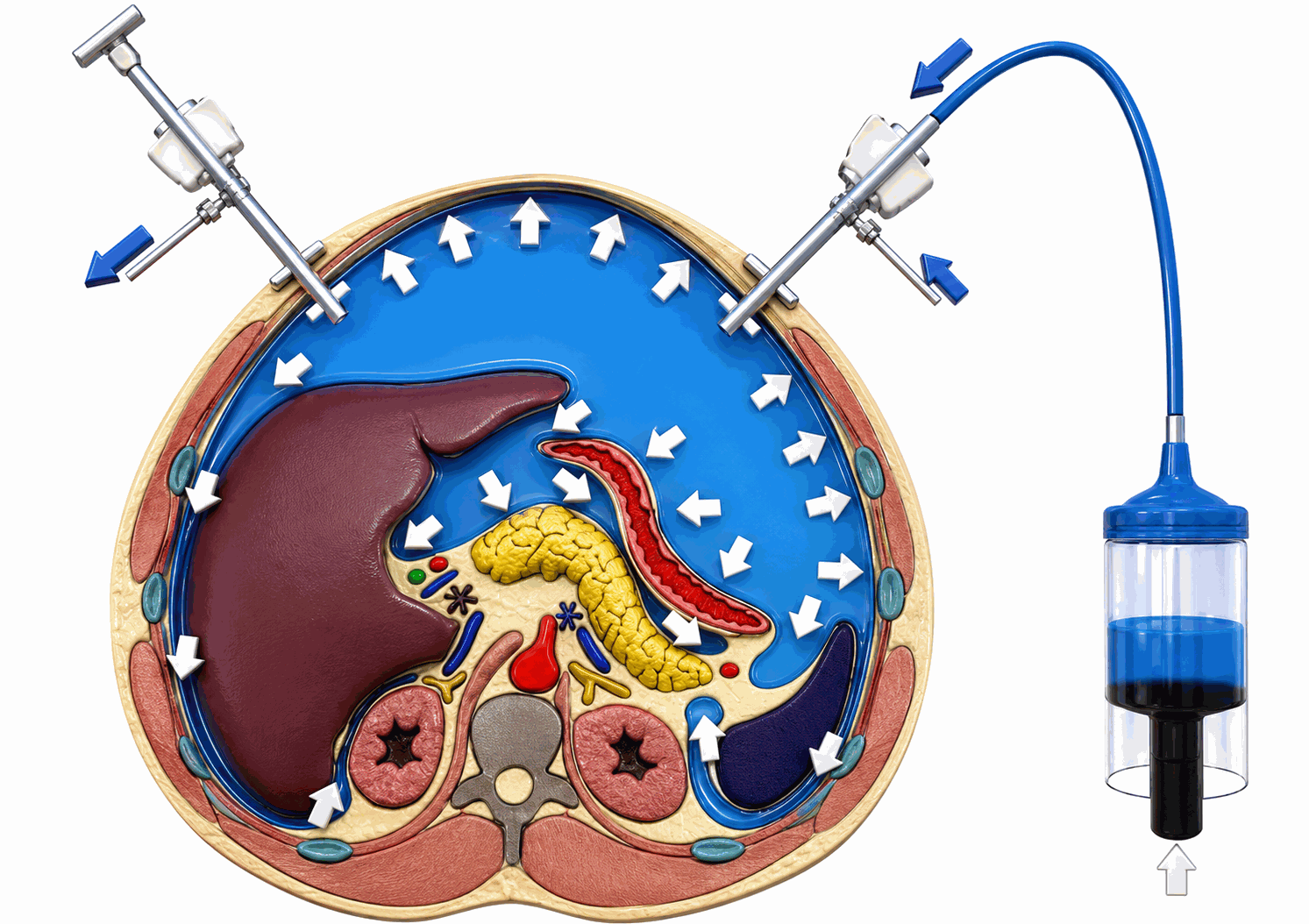 PIPAC Procedure