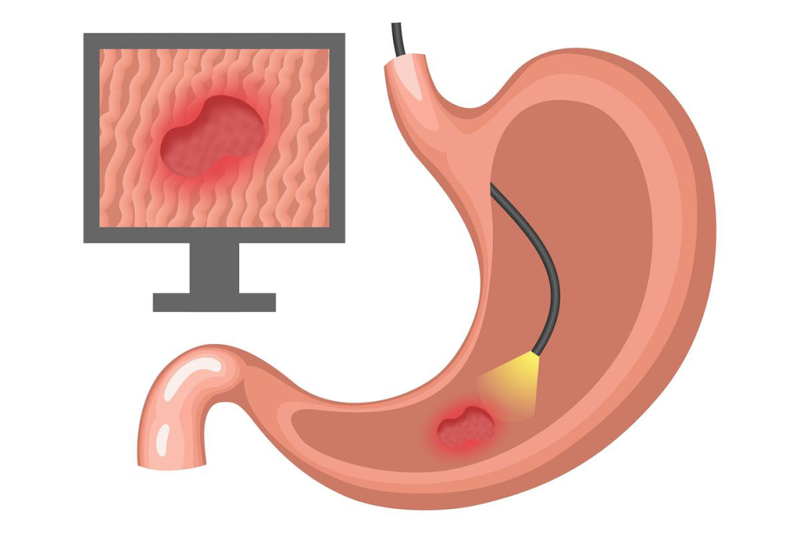 Upper GI Endoscopy Procedure