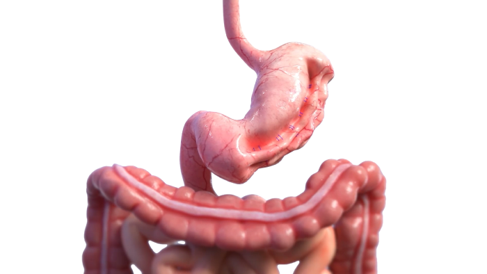 Endoscopic Weight Loss
