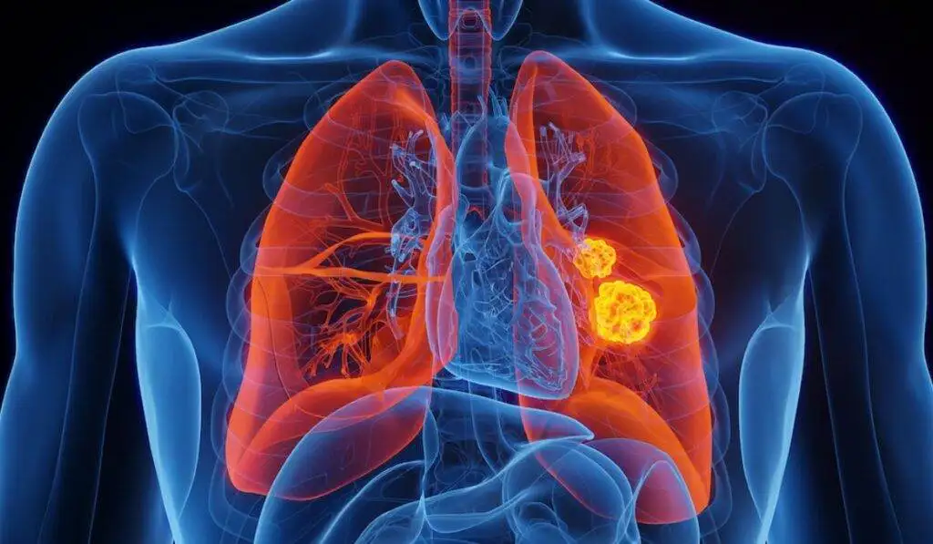 Neuroendocrine Tumor Anatomy