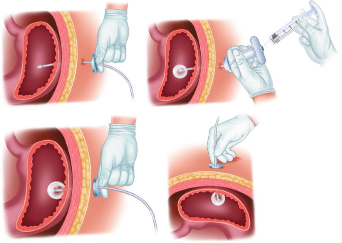 PEG Tube Placement