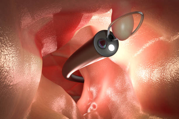 Polypectomy Procedure