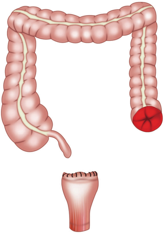 Stoma Care and Support